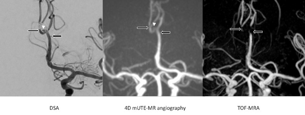 脳動脈瘤に対するステントアシストコイル塞栓術後の血管描出ならびに残存血流評価におけるエコー時間の短い非造影4D MRA の有用性の画像