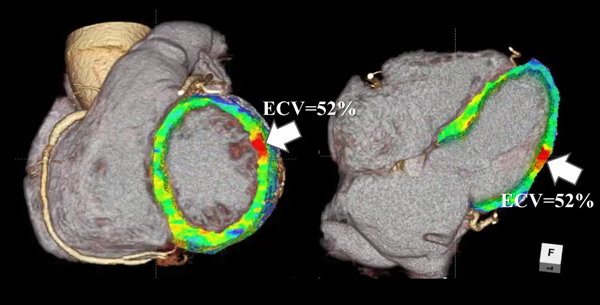 心臓CTによる心筋障害の定量化の画像