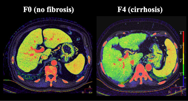 スペクトラル・イメージングによる肝線維化の可視化の画像