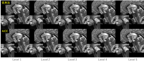 従来法および人工知能（AiCE）によるMRI画像のノイズ低減の画像