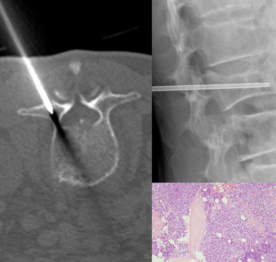 病的圧迫骨折(転移性骨腫瘍)に対する CT/X線透視下経皮的生検