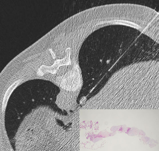 食道奇静脈陥凹部の小肺結節に対するCT ガイド下経皮的肺生検(肺過誤腫)